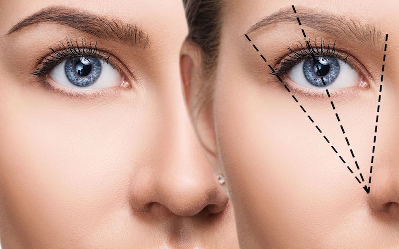 Brow Lift - Lifting des sourcils