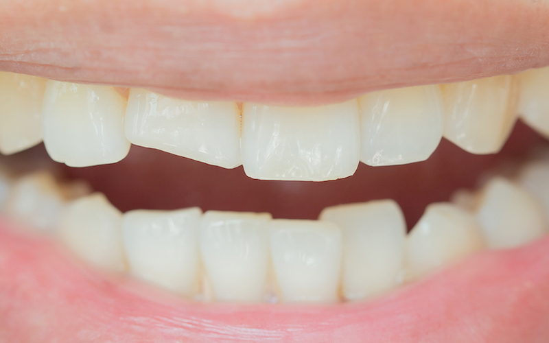 Bruxisme - Grincement des dents