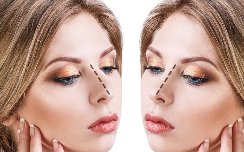 Rhinoplastie de la pointe du nez