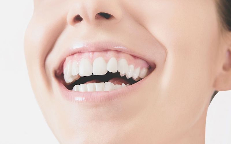 Traitement pour le sourire gingival