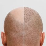 MH Clinique - Catégorie Prestation - Alopécie et Perte de Cheveux - Greffe Capillaire